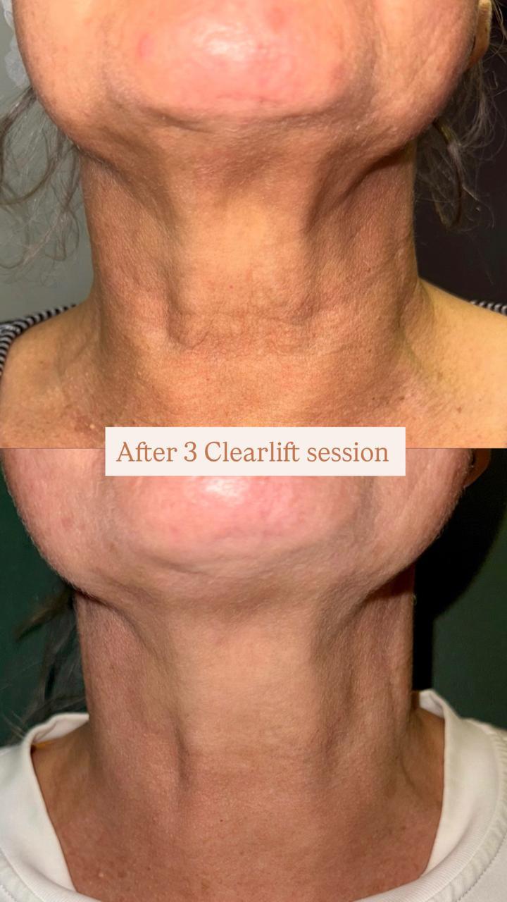 Neck Clearlift — before and after three IPL sessions