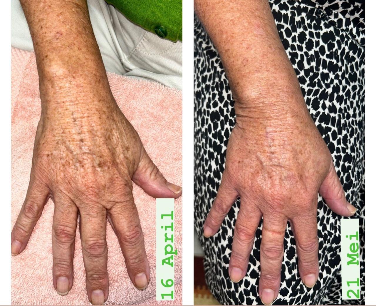 Hand pigmentation — before and after IPL