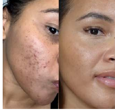 Acne clearance — before and after